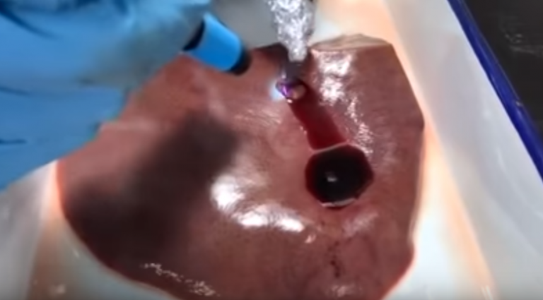 Vedci vyvinuli zázračné lepidlo, ktoré dokáže zastaviť takmer akékoľvek krvácanie behom niekoľkých sekúnd
