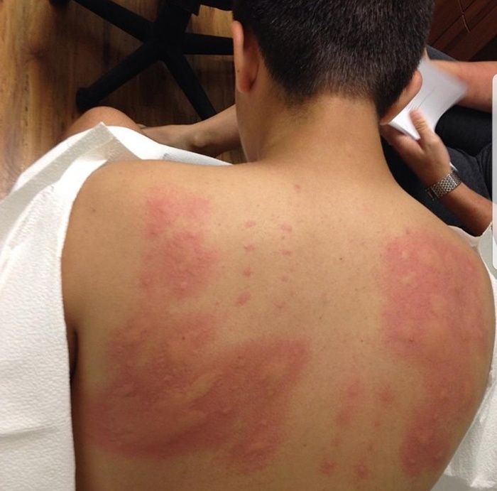 things gone wrong man allergic to almost everything on allergy skin test