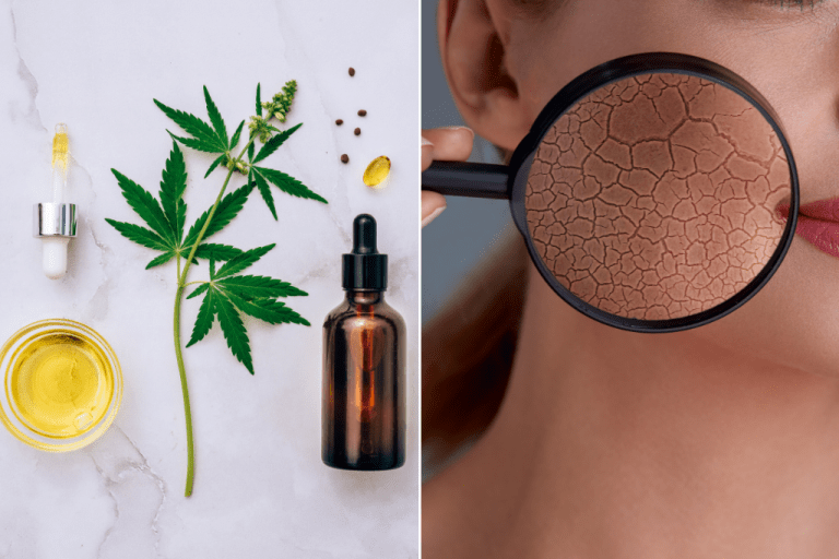 CBD olej a jeho účinky na pleť – Pomôže s akné?