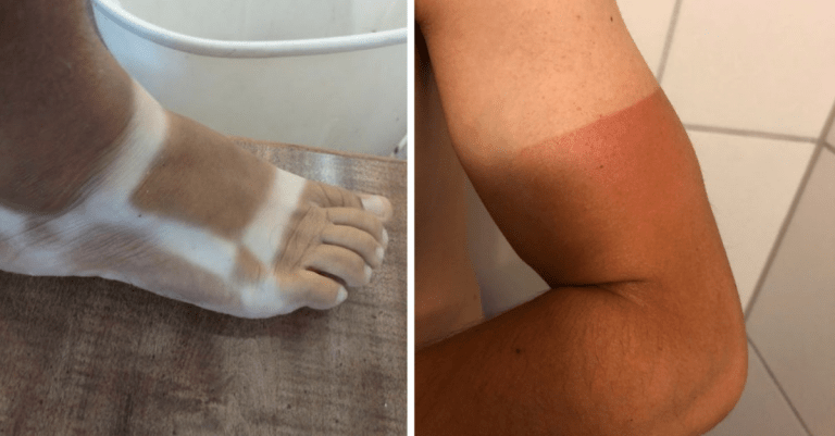 14 fotografií od ľudí, ktorí to s opálením akosi neodhadli