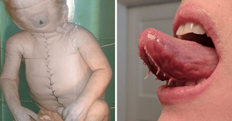 Vzácne genetické poruchy, ktorých prejavy sa vám budú zdať ohavné.