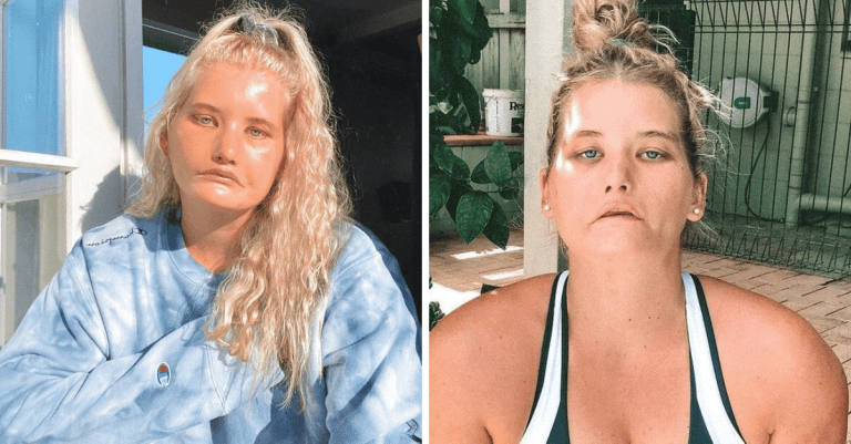Žena, ktorá sa nedokáže usmievať, sa stala úspešnou modelkou. Pozrite sa, ako dnes vyzerá