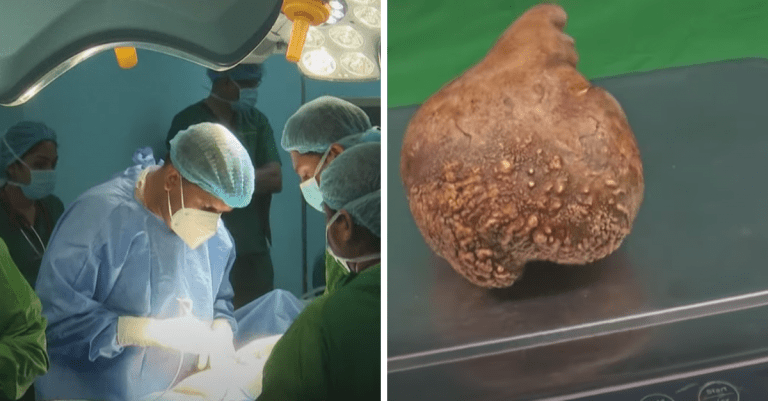 Trápili ho bolesti brucha. Mužovi zo Srí Lanky vyoperovali najväčší obličkový kameň na svete