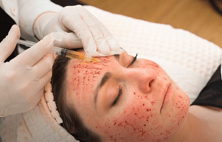 Upírsky facelift – kvôli tejto procedúre sa v kúpeľoch nakazili klienti HIV