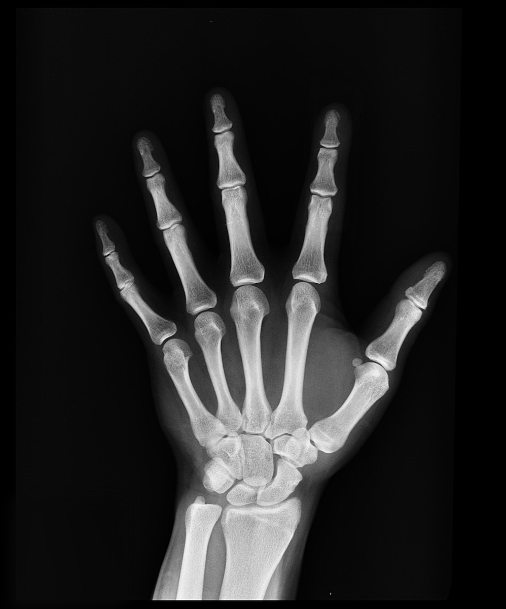 Hand X-ray Result