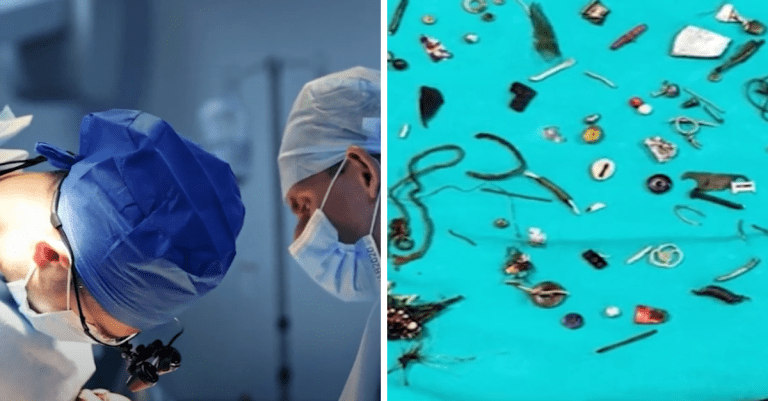 Muž sa sťažoval na bolesti brucha. Lekári mu našli v tele viac ako 60 rôznych predmetov