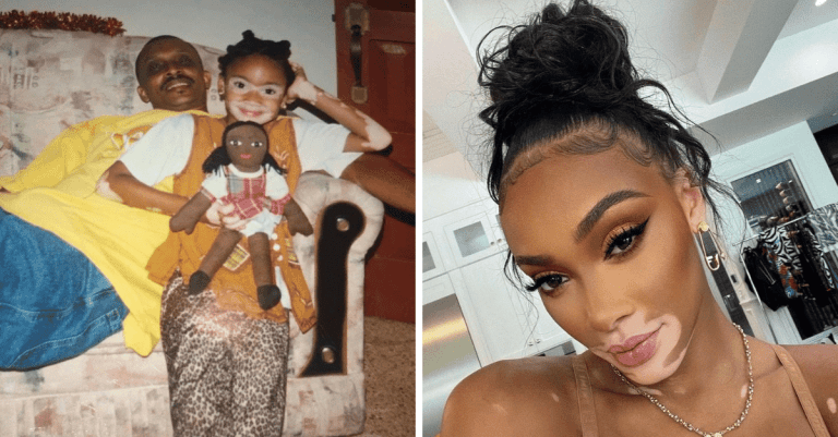Životný príbeh Winnie Harlow: Od odvrhnutého dieťaťa až po topmodelku