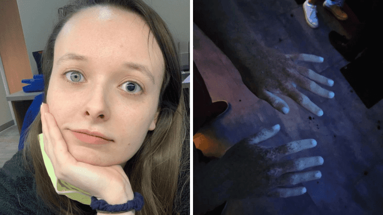 10+ výnimočných ľudí, ktorí sa podelili o svoje nezvyčajné fyzické črty