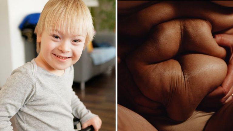 Ochorenia, za ktorými môžu stáť genetické mutácie. Tento zoznam vás prekvapí.