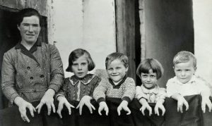 Ectrodactyly Family 1930