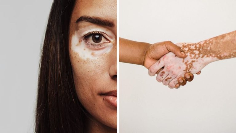 Vitiligo – ochorenie, o ktorom sa oplatí dozvedieť viac, týka sa totiž nielen ľudí, ale aj zvierat