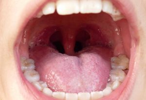 children with oral health and tonsillitis