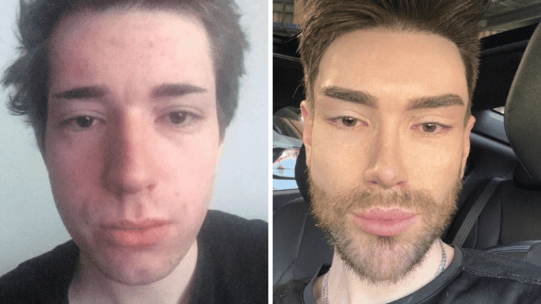 Snažil sa vyzerať ako Ken, potom si nechal odstrániť výplne a podstúpil ďalšie zákroky: Aký človek je z neho dnes?