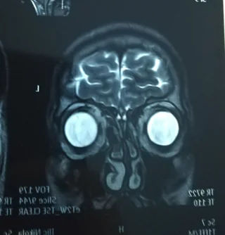 MRI sken ľudskej hlavy zobrazuje mozgové štruktúry zvislým rezom.