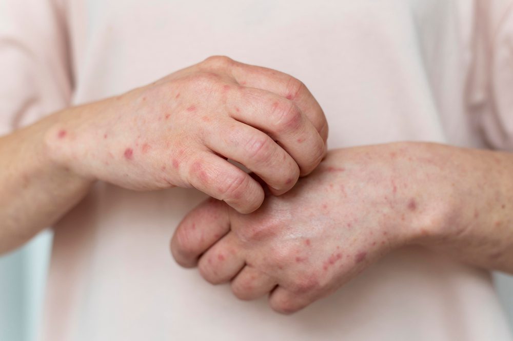 Ruky s červenými vyrážkami, pravdepodobne príklad kožnej alergie alebo dermatitídy.
