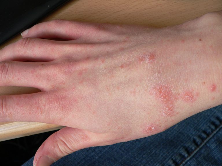 Ruka so začervenanou pokožkou a vyrážkami na chrbte ruky, znaky dermatologického ochorenia alebo alergickej reakcie.