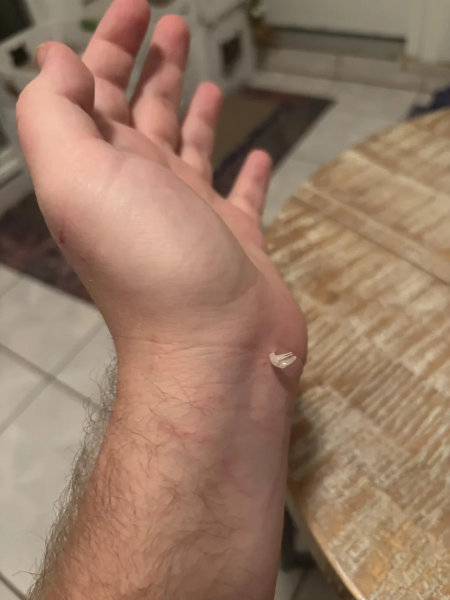 Ruka s menšou drevenou trieskou v koži, detailný záber na zápästie a dlaň v interiéri.