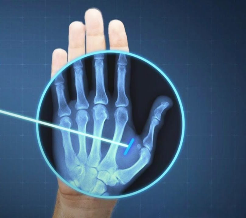Röntgen ruky so zvýraznením implantovaného mikročipu pre pokročilé biometrické technológie.