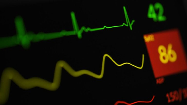 Monitor vitálnych funkcií srdca zobrazuje grafy EKG a hodnoty tepovej frekvencie.
