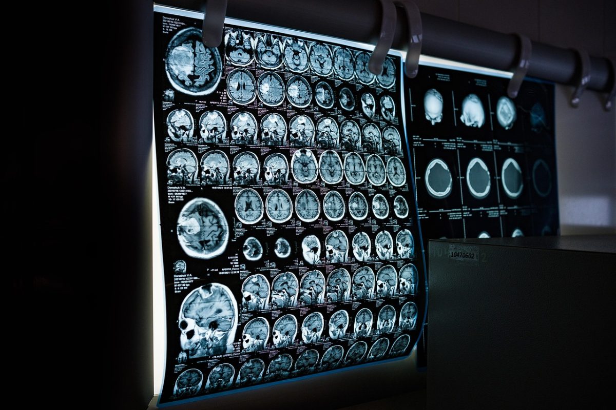 Röntgenové snímky mozgu na svetle zobrazujú rôzne rezy a detaily pre lekársku diagnostiku.