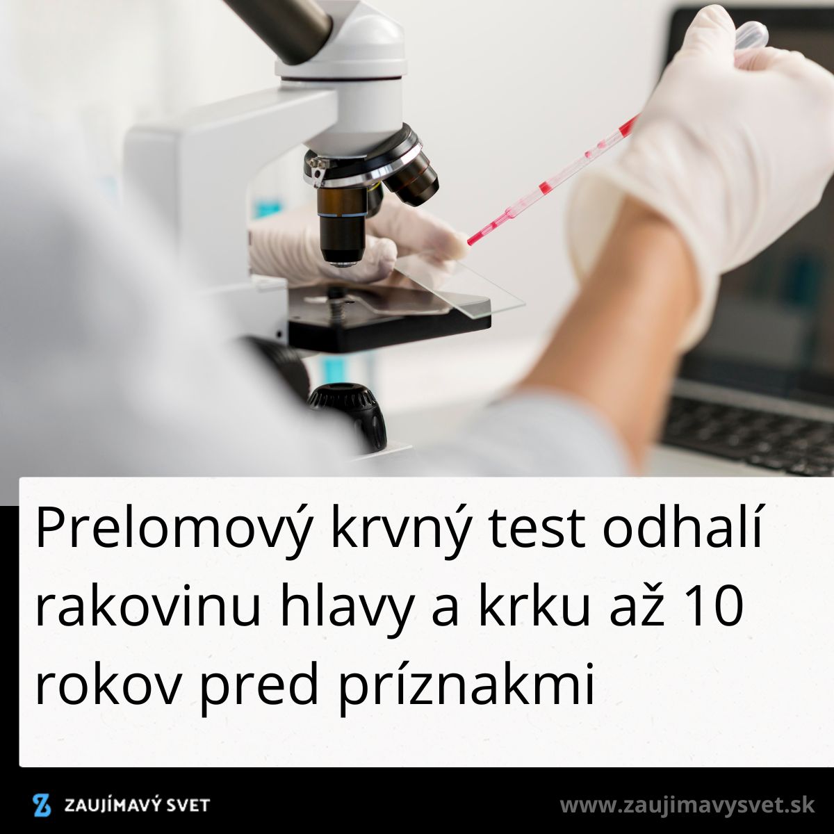 Krvný test pod mikroskopom odhaľujúci rakovinu hlavy a krku v ranom štádiu.