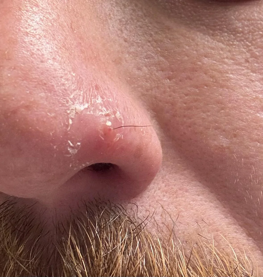 Detailný záber na suchú pokožku a vyrážku na okraji nosa muža s fúzmi.