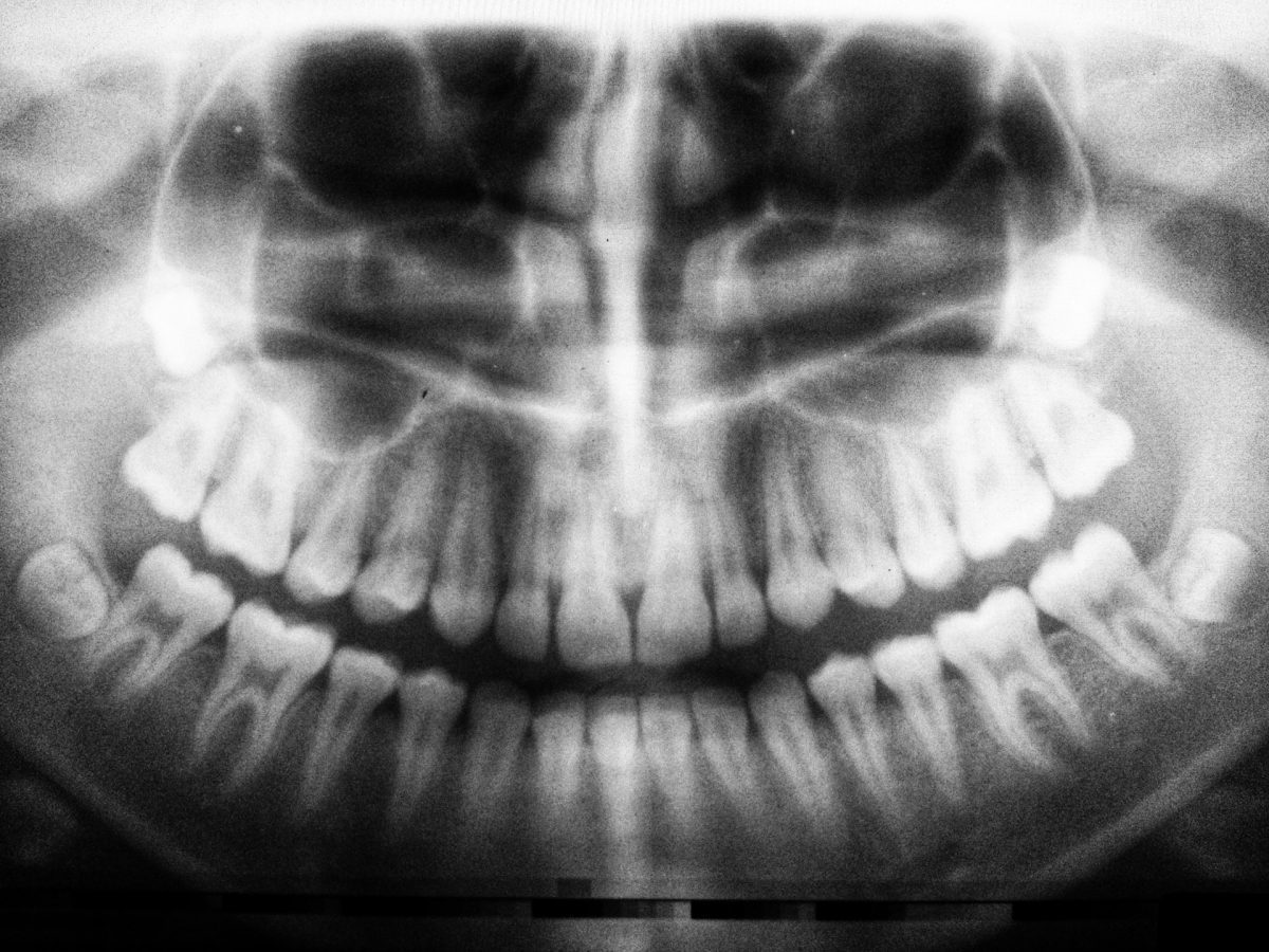 Röntgenový snímok ľudskej čeľuste, zobrazuje kompletný chrup a štruktúru kosti, vhodný pre diagnostiku zubných problémov.
