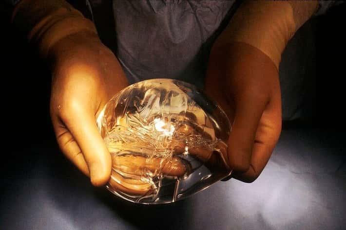 Ruky v chirurgických rukaviciach držia poškodený silikónový prsný implantát.