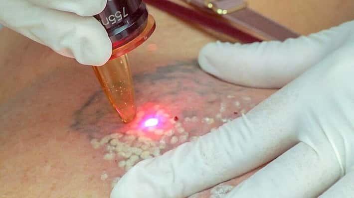 Laserové odstraňovanie kŕčových žíl na koži pomocou lekárskeho zariadenia v rukaviciach.