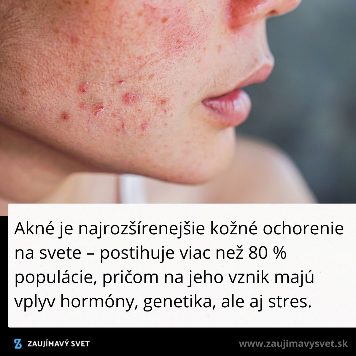 Tvár s akné, najčastejším kožným ochorením; ovplyvnené hormónmi a genetikou.