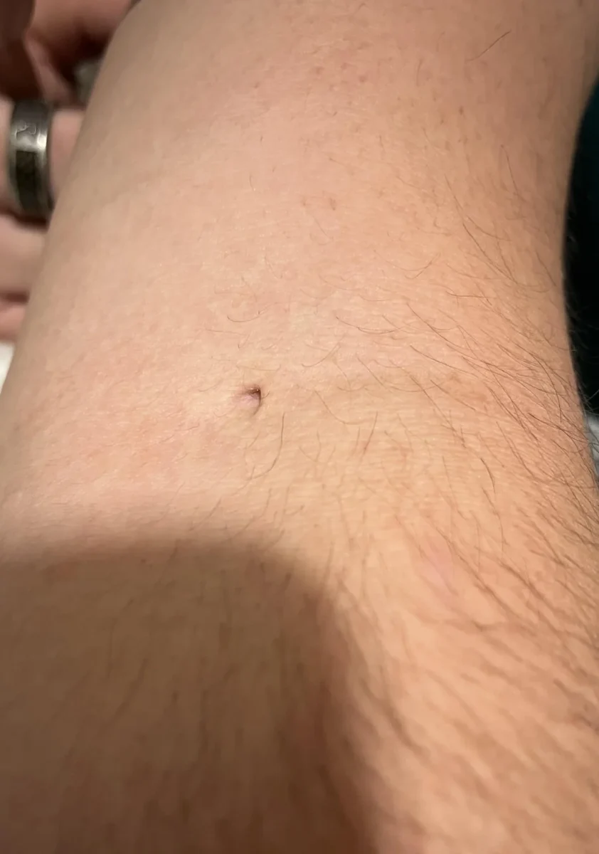 Zblízka kožné lézie na ruke s jemným ochlpením, detail pokožky pod svetlom.