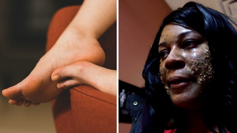 10 najnechutnejších faktov o ľudskej koži, ktoré vás prekvapia