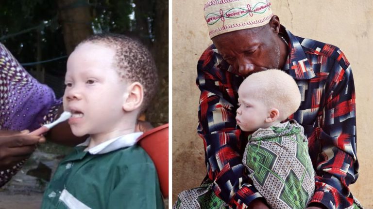 10 šokujúcich faktov o prenasledovaní ľudí s albinizmom v Afrike. Niektoré praktiky sú priam desivé
