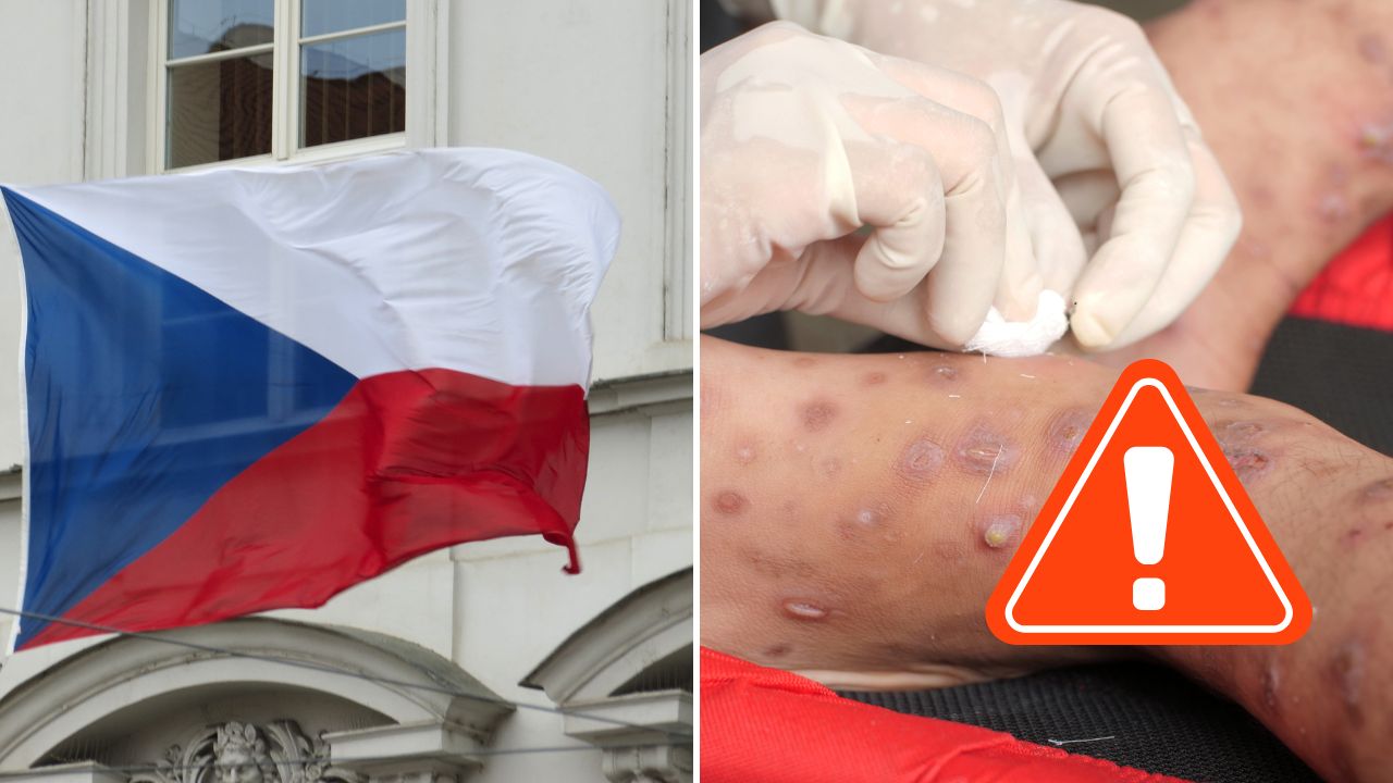 V Česku prudko pribúda svrab. Hygienici evidujú tisíce nakazených aj úmrtia