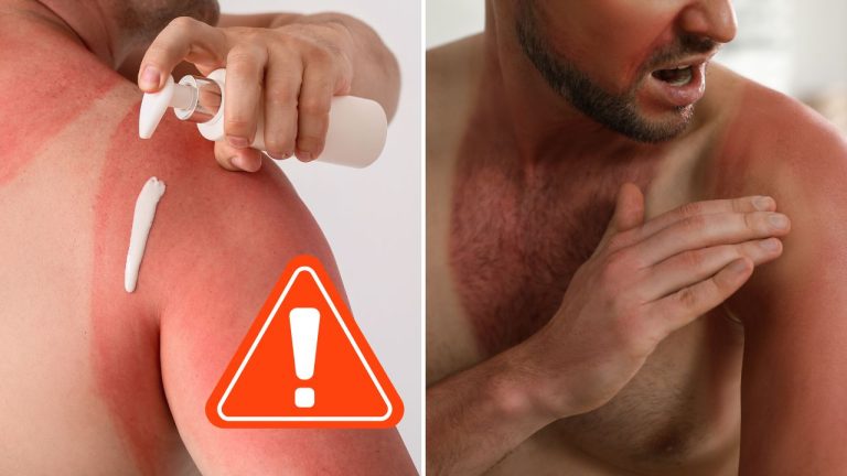 Jedno silné spálenie od slnka môže zanechať celoživotné následky, ukazuje výskum