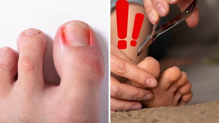 Bolestivý problém, ktorý dokáže poriadne potrápiť: Zarastený necht nemusí vždy skončiť u chirurga!